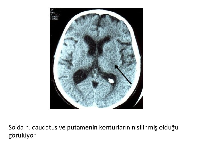 Solda n. caudatus ve putamenin konturlarının silinmiş olduğu görülüyor 