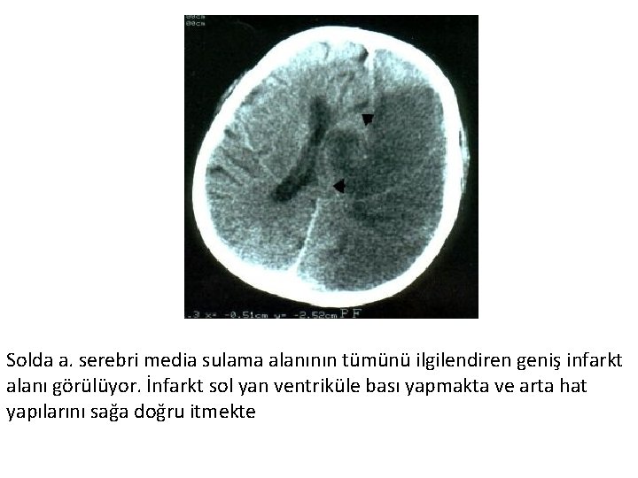 Solda a. serebri media sulama alanının tümünü ilgilendiren geniş infarkt alanı görülüyor. İnfarkt sol