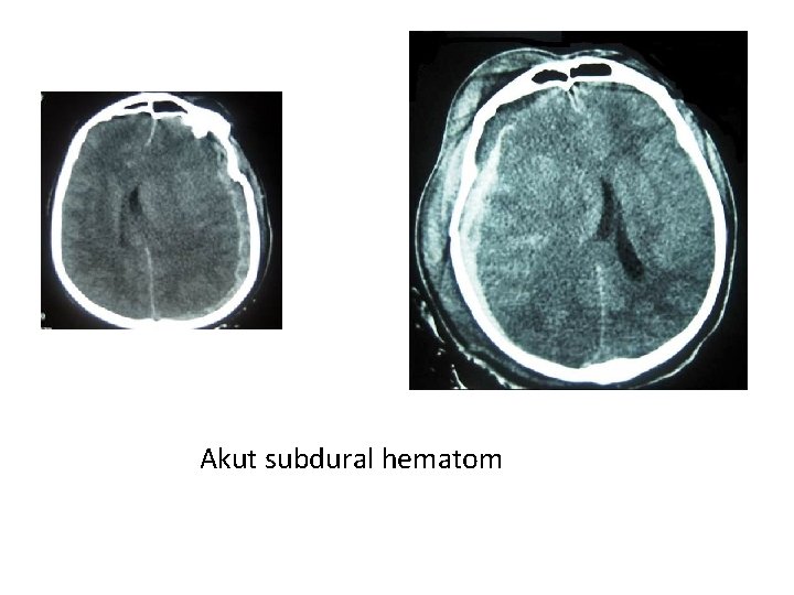 Akut subdural hematom 