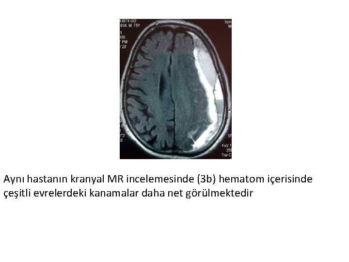 Aynı hastanın kranyal MR incelemesinde (3 b) hematom içerisinde çeşitli evrelerdeki kanamalar daha net