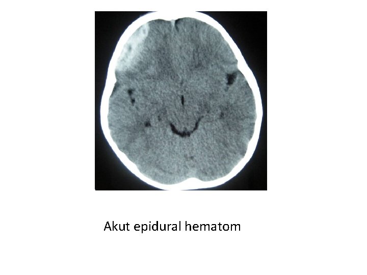 Akut epidural hematom 