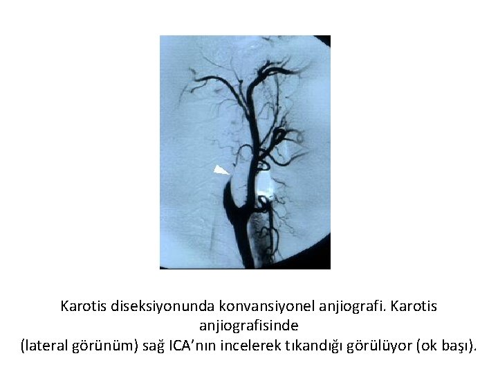 Karotis diseksiyonunda konvansiyonel anjiografi. Karotis anjiografisinde (lateral görünüm) sağ ICA’nın incelerek tıkandığı görülüyor (ok