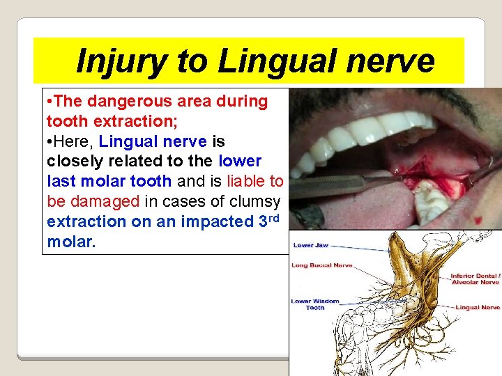 Injury to Lingual nerve • The dangerous area during tooth extraction; • Here, Lingual