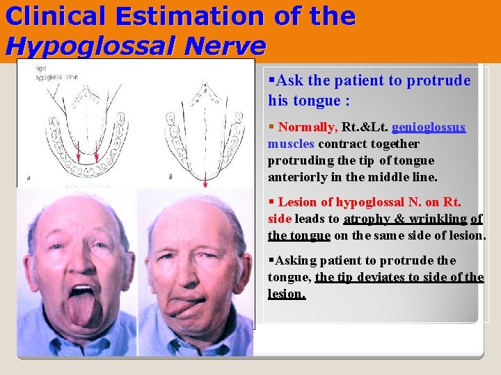 Clinical Estimation of the Hypoglossal Nerve §Ask the patient to protrude his tongue :