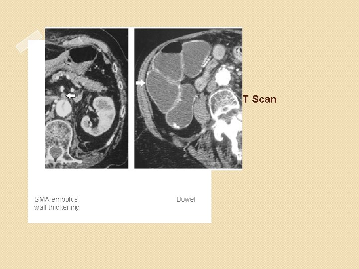 CT Scan SMA embolus wall thickening Bowel 