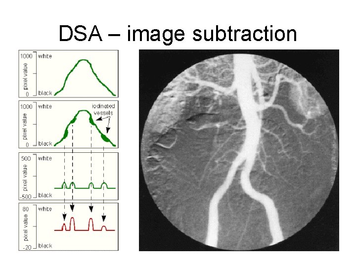 DSA – image subtraction DSA – image subtraction
