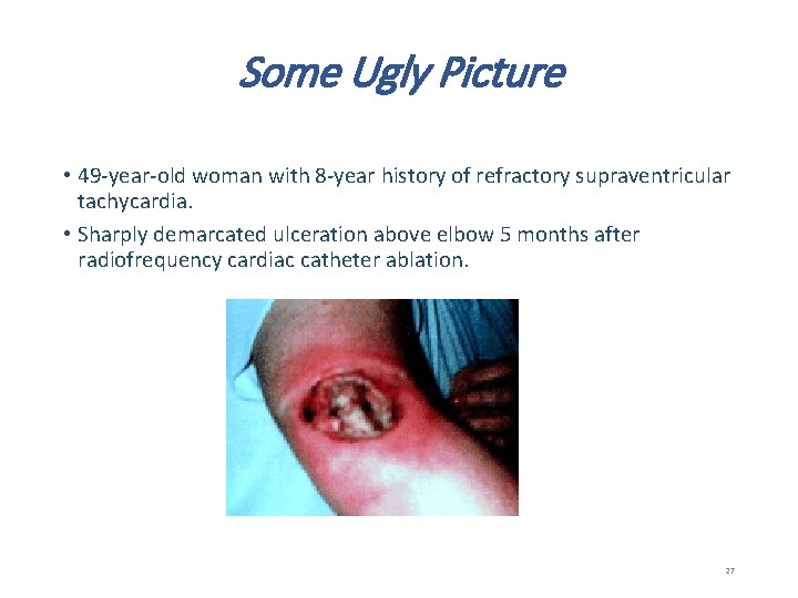 Some Ugly Picture • 49 -year-old woman with 8 -year history of refractory supraventricular