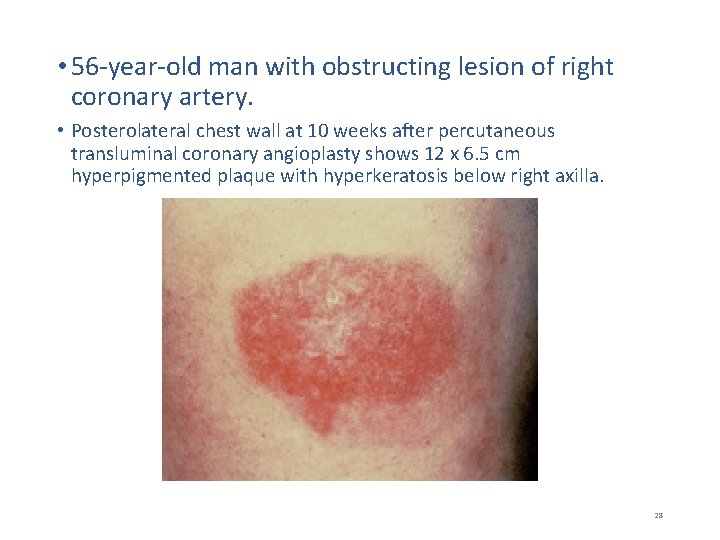  • 56 -year-old man with obstructing lesion of right coronary artery. • Posterolateral