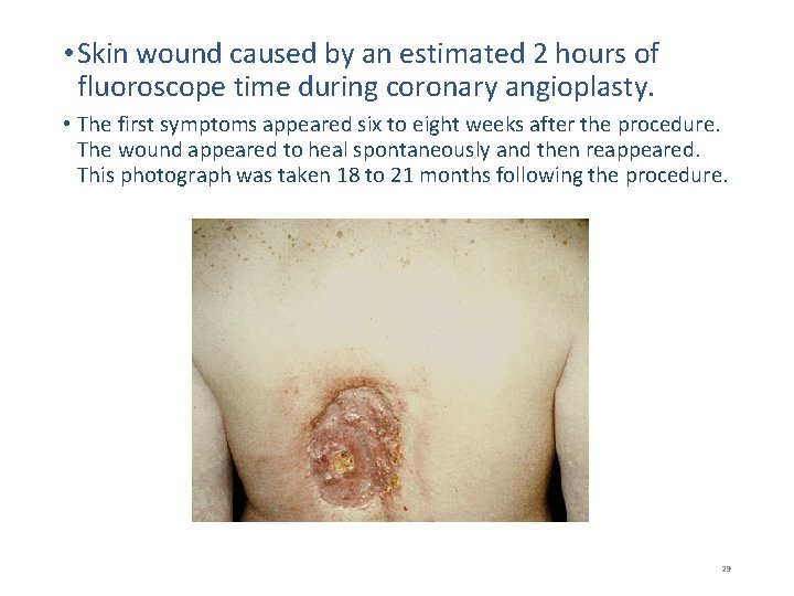  • Skin wound caused by an estimated 2 hours of fluoroscope time during