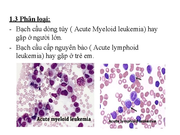 1. 3 Phân loại: - Bạch cầu dòng tủy ( Acute Myeloid leukemia) hay