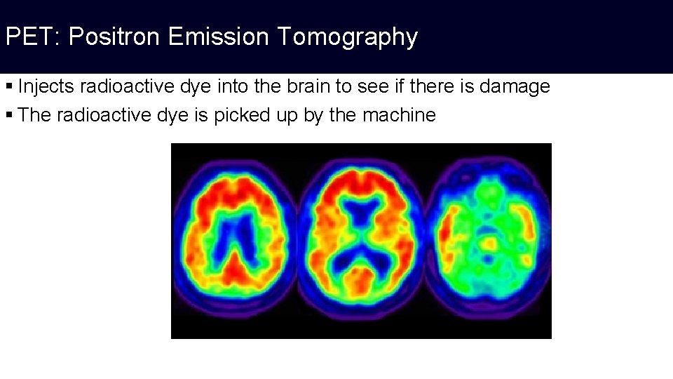 PET: Positron Emission Tomography § Injects radioactive dye into the brain to see if