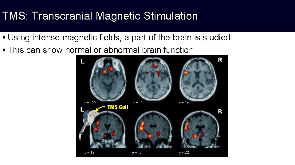 TMS: Transcranial Magnetic Stimulation § Using intense magnetic fields, a part of the brain