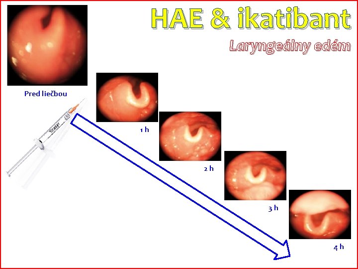 HAE & ikatibant Laryngeálny edém Pred liečbou 1 h 2 h 3 h 4