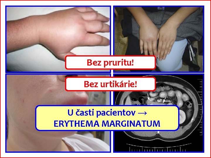 Bez pruritu! Bez urtikárie! U časti pacientov → ERYTHEMA MARGINATUM 