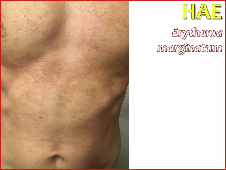 HAE Erythema marginatum 