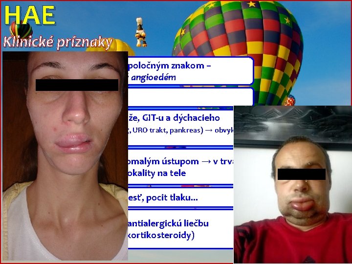 HAE Klinické príznaky Skupina ochorení s jedným spoločným znakom – nealergický, nehistamínergný angioedém Celoživotné