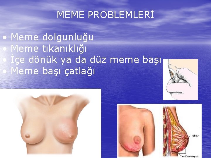 MEME PROBLEMLERİ • • Meme dolgunluğu Meme tıkanıklığı İçe dönük ya da düz meme