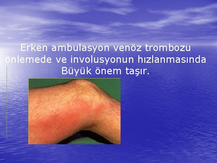 Erken ambulasyon venöz trombozu önlemede ve involusyonun hızlanmasında Büyük önem taşır. 