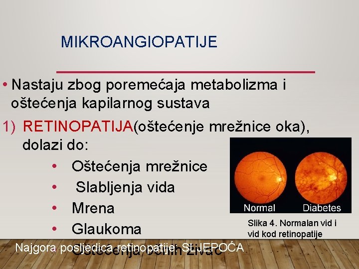 MIKROANGIOPATIJE • Nastaju zbog poremećaja metabolizma i oštećenja kapilarnog sustava 1) RETINOPATIJA(oštećenje mrežnice oka),