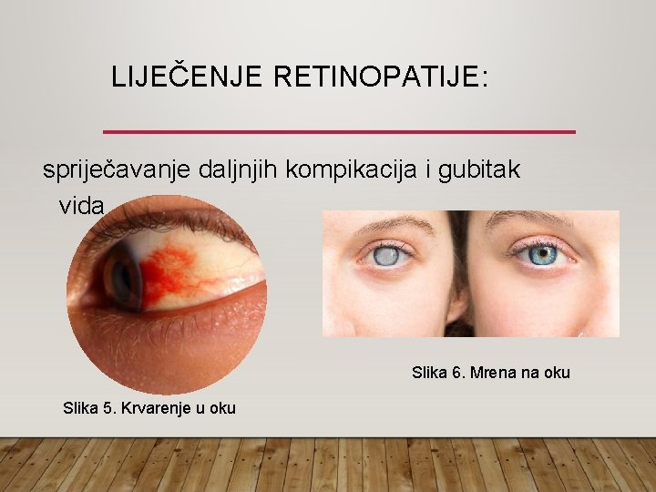 LIJEČENJE RETINOPATIJE: spriječavanje daljnjih kompikacija i gubitak vida Slika 6. Mrena na oku Slika