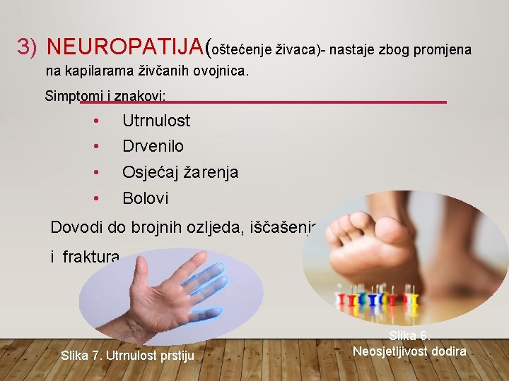 3) NEUROPATIJA(oštećenje živaca)- nastaje zbog promjena na kapilarama živčanih ovojnica. Simptomi i znakovi: •