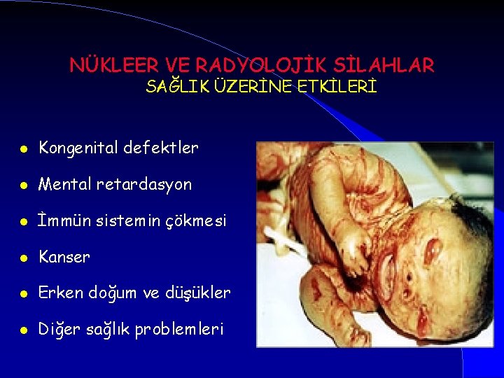 NÜKLEER VE RADYOLOJİK SİLAHLAR SAĞLIK ÜZERİNE ETKİLERİ l Kongenital defektler l Mental retardasyon l