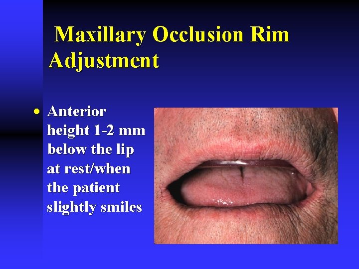 Maxillary Occlusion Rim Adjustment · Anterior height 1 -2 mm below the lip at Maxillary Occlusion Rim Adjustment · Anterior height 1 -2 mm below the lip at