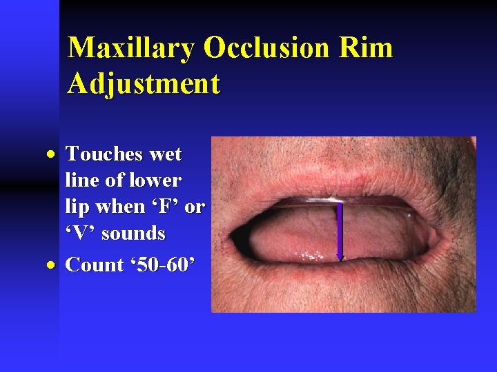 Maxillary Occlusion Rim Adjustment · Touches wet line of lower lip when ‘F’ or Maxillary Occlusion Rim Adjustment · Touches wet line of lower lip when ‘F’ or