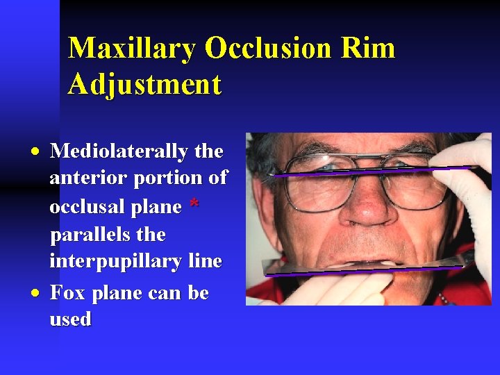Maxillary Occlusion Rim Adjustment · Mediolaterally the anterior portion of occlusal plane * parallels Maxillary Occlusion Rim Adjustment · Mediolaterally the anterior portion of occlusal plane * parallels