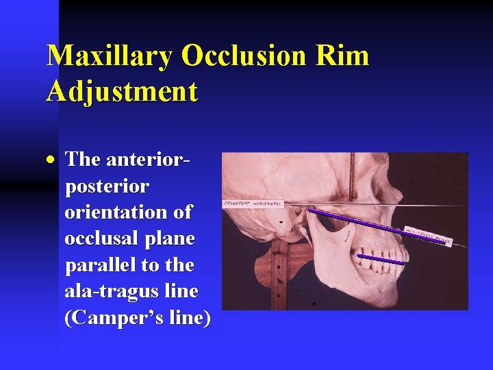 Maxillary Occlusion Rim Adjustment · The anteriorposterior orientation of occlusal plane parallel to the Maxillary Occlusion Rim Adjustment · The anteriorposterior orientation of occlusal plane parallel to the