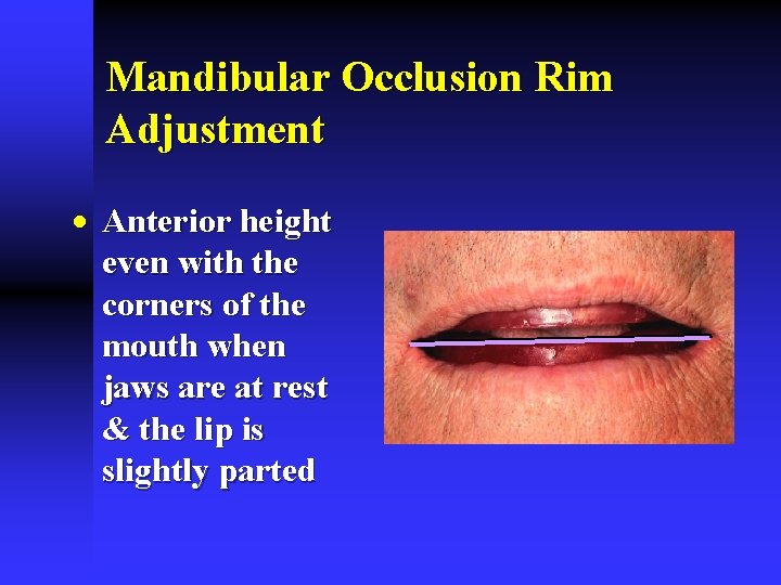 Mandibular Occlusion Rim Adjustment · Anterior height even with the corners of the mouth Mandibular Occlusion Rim Adjustment · Anterior height even with the corners of the mouth
