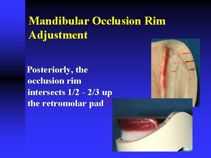 Mandibular Occlusion Rim Adjustment Posteriorly, the occlusion rim intersects 1/2 - 2/3 up the Mandibular Occlusion Rim Adjustment Posteriorly, the occlusion rim intersects 1/2 - 2/3 up the