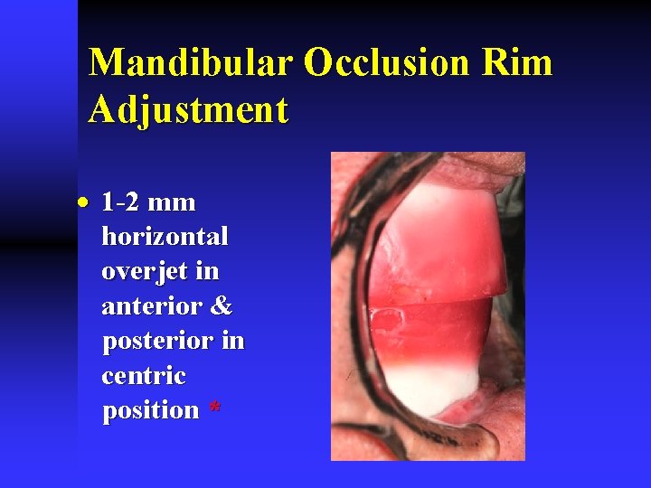 Mandibular Occlusion Rim Adjustment · 1 -2 mm horizontal overjet in anterior & posterior Mandibular Occlusion Rim Adjustment · 1 -2 mm horizontal overjet in anterior & posterior