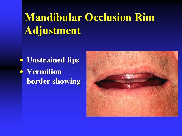 Mandibular Occlusion Rim Adjustment · Unstrained lips · Vermilion border showing Mandibular Occlusion Rim Adjustment · Unstrained lips · Vermilion border showing