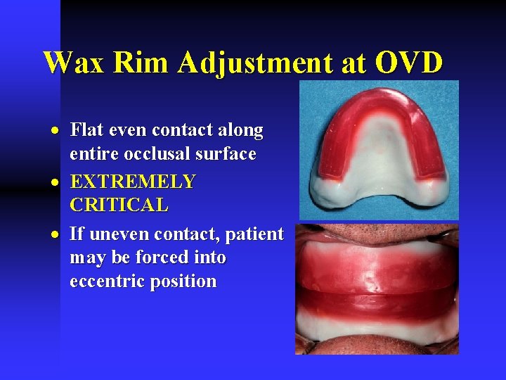Wax Rim Adjustment at OVD · Flat even contact along entire occlusal surface · Wax Rim Adjustment at OVD · Flat even contact along entire occlusal surface ·