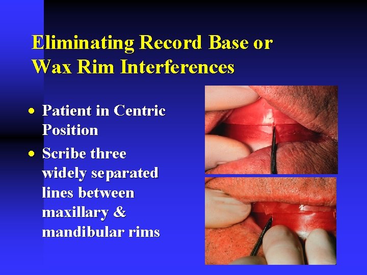 Eliminating Record Base or Wax Rim Interferences · Patient in Centric Position · Scribe Eliminating Record Base or Wax Rim Interferences · Patient in Centric Position · Scribe