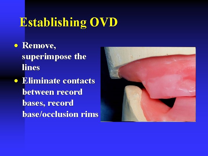 Establishing OVD · Remove, superimpose the lines · Eliminate contacts between record bases, record Establishing OVD · Remove, superimpose the lines · Eliminate contacts between record bases, record