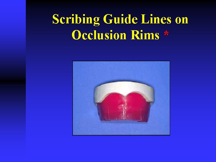 Scribing Guide Lines on Occlusion Rims * Scribing Guide Lines on Occlusion Rims *