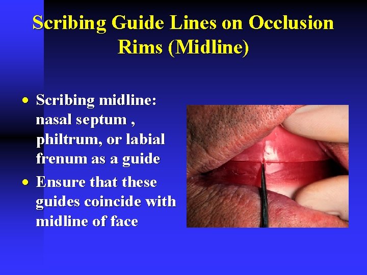 Scribing Guide Lines on Occlusion Rims (Midline) · Scribing midline: nasal septum , philtrum, Scribing Guide Lines on Occlusion Rims (Midline) · Scribing midline: nasal septum , philtrum,