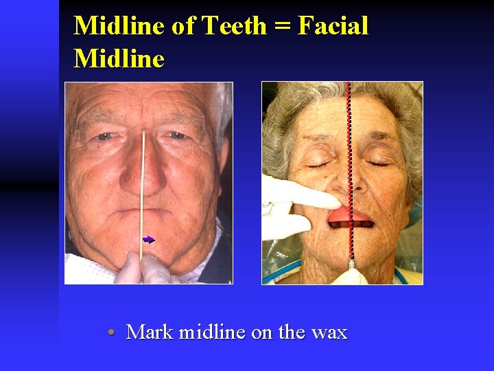 Midline of Teeth = Facial Midline • Mark midline on the wax Midline of Teeth = Facial Midline • Mark midline on the wax