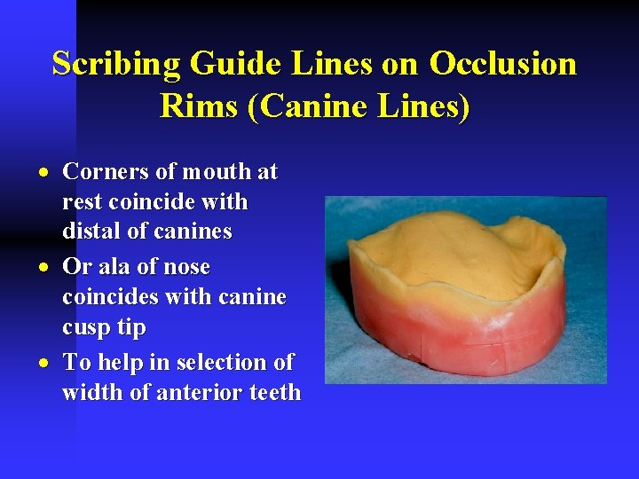 Scribing Guide Lines on Occlusion Rims (Canine Lines) · Corners of mouth at rest Scribing Guide Lines on Occlusion Rims (Canine Lines) · Corners of mouth at rest