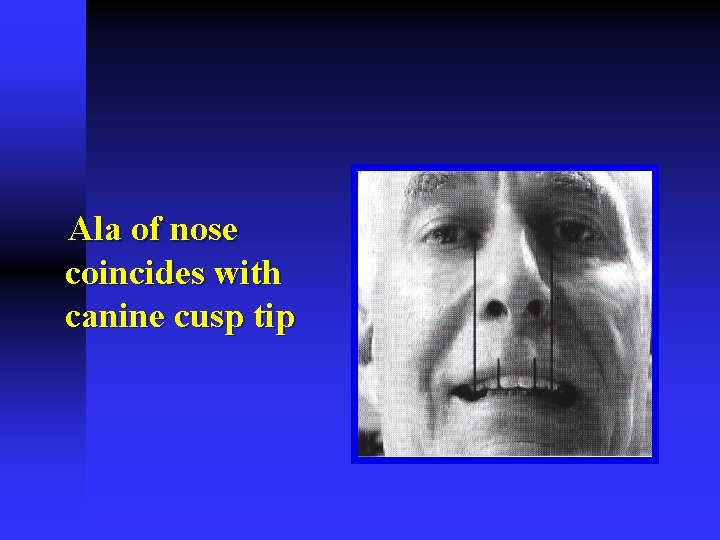 Ala of nose coincides with canine cusp tip Ala of nose coincides with canine cusp tip