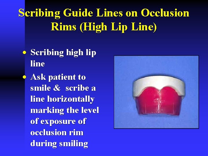 Scribing Guide Lines on Occlusion Rims (High Lip Line) · Scribing high lip line Scribing Guide Lines on Occlusion Rims (High Lip Line) · Scribing high lip line