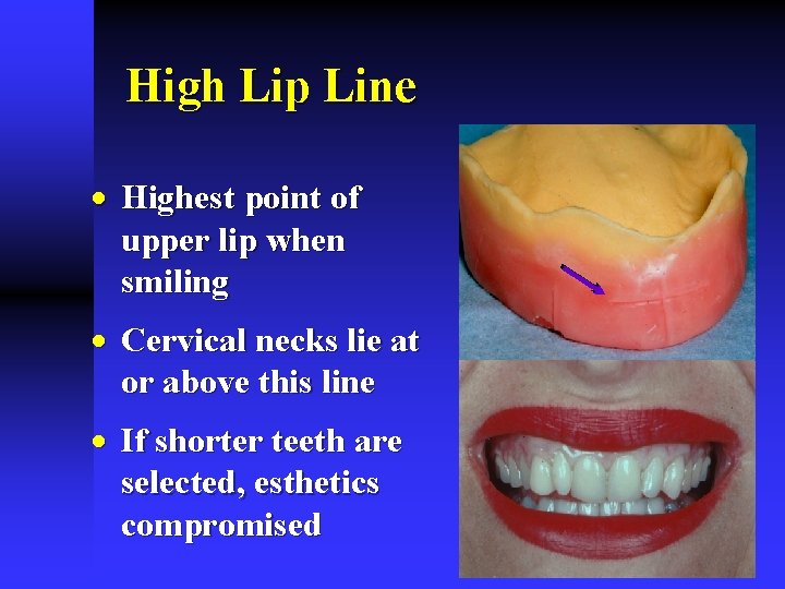 High Lip Line · Highest point of upper lip when smiling · Cervical necks High Lip Line · Highest point of upper lip when smiling · Cervical necks