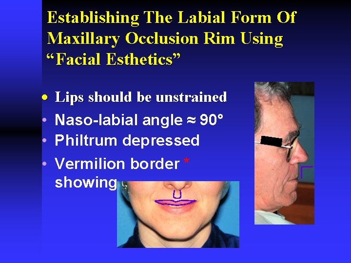Establishing The Labial Form Of Maxillary Occlusion Rim Using “Facial Esthetics” · • • Establishing The Labial Form Of Maxillary Occlusion Rim Using “Facial Esthetics” · • •