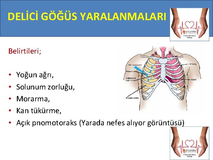DELİCİ GÖĞÜS YARALANMALARI Belirtileri; • • • Yoğun ağrı, Solunum zorluğu, Morarma, Kan tükürme,