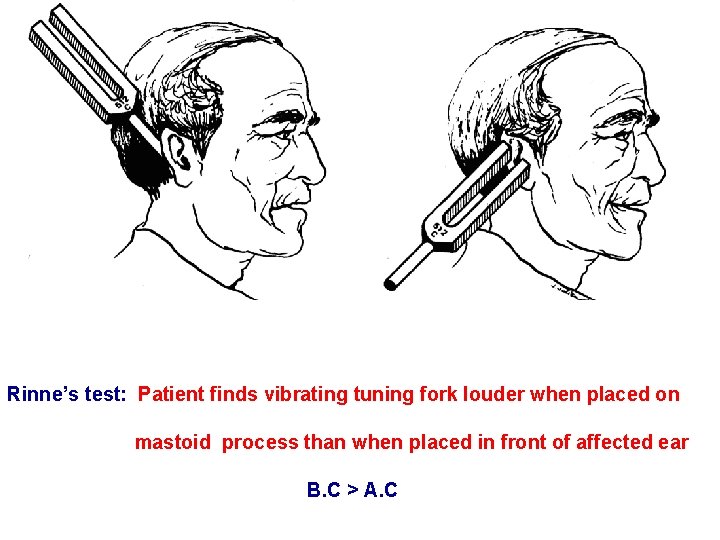 Rinne’s test: Patient finds vibrating tuning fork louder when placed on mastoid process than