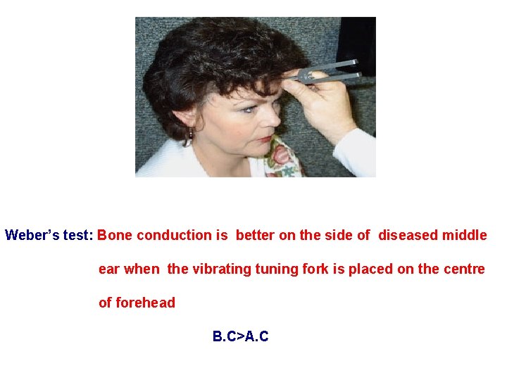 Weber’s test: Bone conduction is better on the side of diseased middle ear when