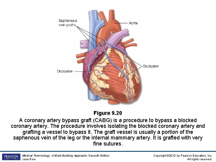 Figure 9. 20 A coronary artery bypass graft (CABG) is a procedure to bypass