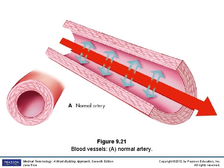 Figure 9. 21 Blood vessels: (A) normal artery. Medical Terminology: A Word-Building Approach, Seventh